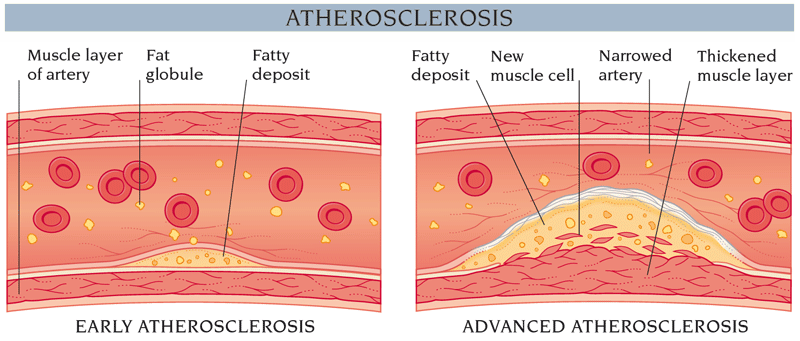 atherosclerosis.gif