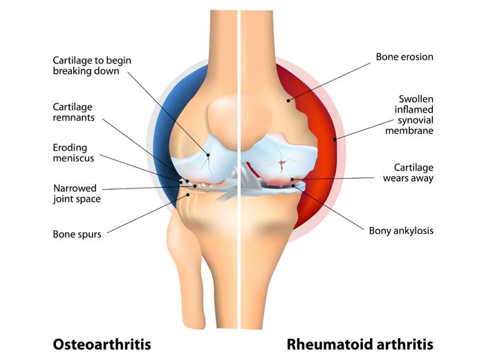 rheumatoid arthritis.jpg