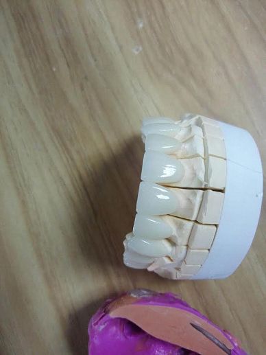 Zirconia Crown Outsource To China